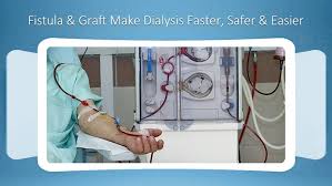 Pin On Av Fistula Surgery Spring Hill Florida