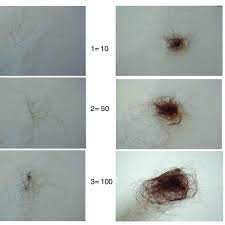 At an approximate rate, healthy hair in a human grows at 0.35 mm/day 1. Hair Shedding Scale Women Are Asked Which Image Best Corresponds To Download Scientific Diagram