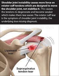 The acromioclavicular joint is where the acromion, part of the shoulder blade (scapula) and the collar bone (clavicle) meet. Rotator Cuff Tendinopathy Comparing Injections And Surgical Options Caring Medical Florida