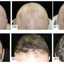 It is an advanced form of alopecia areata, which, causes round patches of hair loss. Clinical Changes In Alopecia Totalis With Body Hair Loss Susceptible To Download Scientific Diagram