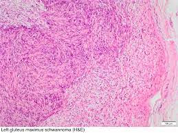 Both symptomatic and occult nonoperated ils were included for further analysis. Pathology Outlines Schwannoma