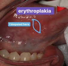 Image result for Erythroplakia roof of mouth