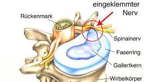 Ein bandscheibenvorfall ist ein durchbruch des gallertkerns einer bandscheibe durch ihren faserring. Wohlfuhlen Bandscheibenvorfall Damit Es Nicht Mehr Schmerzt Augsburger Allgemeine