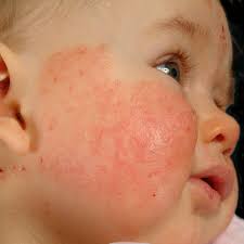 However, if it doesn't subside, it's better to consult your pediatrician or dermatologist especially if you notice the following signs: Atopic Dermatitis Overview Altmeyers Encyclopedia Department Dermatology