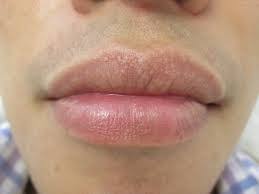Dia mencoba mencium bibir nia. Halo Dokter Sy Mau Bertanya Di Bagian Ujung Bibir Kanan Dan Kiri Ada Bercak Putih Tidak Sakit Tidak Panas Dan Tidak Gatal Knp Ya Dok Teruma Kasih Honestdocs