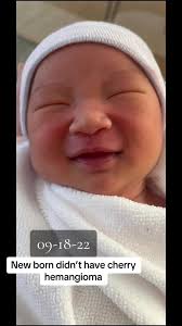 How is cherry hemangioma go away in 1 year old #hemangiomababy