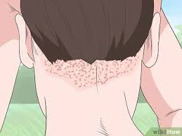 Olete jõudnud sellele lehele, sest see on kõige tõenäolisem otsin: 4 Cara Untuk Menyembuhkan Eksem Kulit Kepala Wikihow