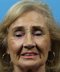 Co2 Laser Before and After