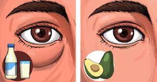 The eyelids may become swollen, and the eyes may become red, itchy, and irritated. 6 Foods That Can Give You Puffy Eyes And 4 That Can Fix Them