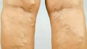 Varicele sunt vene dilatate, proeminente care se inflameaza avand culoarea albastruie, si isi fac, de regula, aparitia la suprafata pielii, in zona coapselor si a gambelor. Leacul Natural Care Te ScapÄƒ De Varice In DouÄƒ SÄƒptÄƒmani Ai Nevoie De 3 Ingrediente