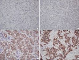 HER2 status in breast cancer: changes in guidelines and complicating  factors for interpretation