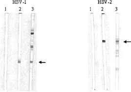 Find symptom,causes and treatments of zoster.for your health. Prevalence Of Antibodies Against Herpes Simplex Virus Types 1 And 2 In Children And Young People In An Urban Region In Tanzania Journal Of Clinical Microbiology
