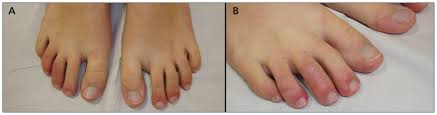 Image result for Chilblains