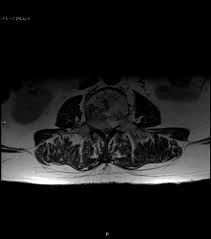 Treatments for chordoma include surgery, chemotherapy, and radiation therapy. Https Www Longdom Org Open Access An Atypical Presentation Of Chordoma Case Report And Review 2161 0533 1000247 Pdf
