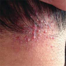 This article will talk about both herpes and ingrown hair and their differences in. Infections Infestations And Neoplasms Of The Scalp Intechopen