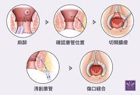 微創肛門膿瘍及廔管手術】發生原因、治療方式、手術前後注意事項| 佳思優整形醫美診所