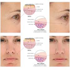 Lightstim For Wrinkles Led Light Therapy Device Premier Look