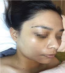 Laser Facial Treatment in Singapore