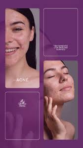 ¡Dile adiós al acné con un peeling químico! 🌟✨, Te mostramos cómo el  tratamiento de peeling químico puede transformar tu piel, eliminando  imperfecciones y reduciendo el acné., ¡Mira el proceso y los ...