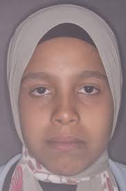 Class III skeletal, Open bite severe, orthodontic treatment pitts protocol,  short light elastics from the first day, tongue tamers. 8 months case  closed...