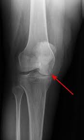 Magnetic resonance imaging (mri) interpretation of the knee is often a daunting challenge to the student or physician in training. Osteonecrosis Of The Knee Orthoinfo Aaos