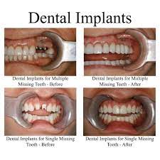 The total cost depends on the size of the dental bridge and the number of implants needed. Dental Implants Costs Procedure Faq Uk Electric Teeth