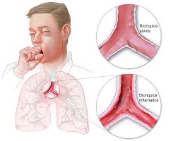 Image result for Acute Bronchitis