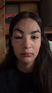 Good morning lakeside, anyone else ever experience this from a mosquito?