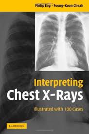 Image result for Chest XRay Interpretation