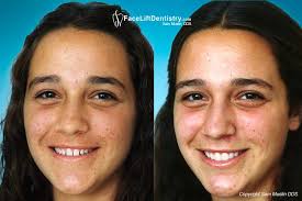 If you have multiple gaps, gaps wider than 5 millimeters, crooked teeth, and you do not want to cover up your existing teeth, then braces might be your best option. Small Teeth Or Short Teeth Treatment Options