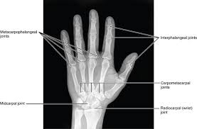 Image result for Hand Growth Plates
