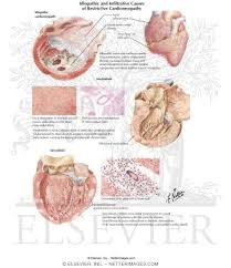 Image result for Restrictive Cardiomyopathy