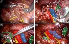 First Rib Resection For Thoracic Outlet Syndrome The Robotic Approach Springerlink