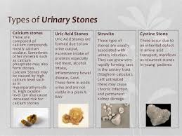 Types Of Kidney Stones Google Search Kidney Treatment Kidney Stones Symptoms Kidney Stones Remedy
