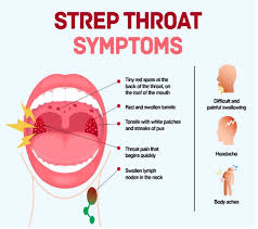 Image result for Strep throat infection roof of mouth