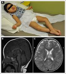 Epicanthic folds is a skin fold on the upper eyelid which covers the inner angle of the eye, which makes them appear smaller and more slanted, even if the eye itself is no different from an eye with no epicanthic fold. Figure 1 From Prune Syndrome Is A New Neurodevelopmental Disorder Semantic Scholar