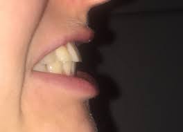 Hilfe Unglucklich Nach Zahnspange Zahne Stehen Nach Vorne Pferdegebiss Kieferorthopade