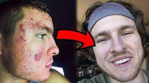 How To Clear Your Acne In Less Than 10 Minutes Youtube