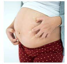 Ginecologo German Fiestas Pflucker Como Aliviar La Comezon En El Embarazo Sientes Molestos Y Continuos Picores En La Piel Sobre Todo En El Abdomen Durante Tu Embarazo La Comezon En El