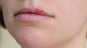 Image result for oral herpes symptoms roof of the mouth