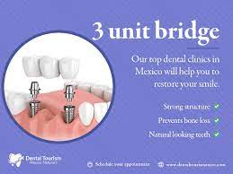 Pin On Dental Bridge Watches