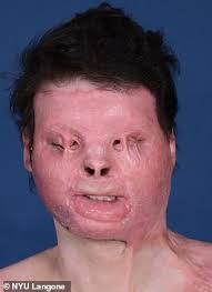 A driver who was terribly burned after falling asleep behind. Tesf0orgtzd05m