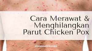11 cara merawat bunga ini perlu untuk diketahui bagi setiap orang yang memiliki tanaman bunga sebagai hiasan ditempatnya. Cara Merawat Dan Menghilangkan Parut Chicken Pox Dengan Cepat Ziana Eunos