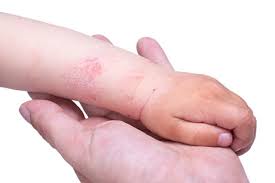 Image result for Atopic eczema atopic dermatitis