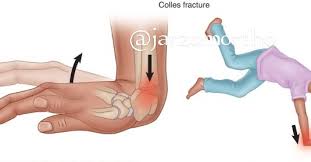 Image result for Fall on Outstretched Hand