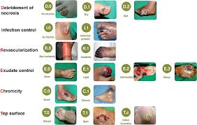 Image result for IDSA Diabetic Foot Wound Classification