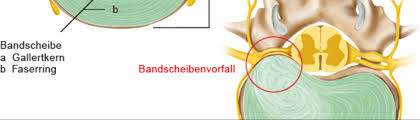 Die bandscheibe eines jungen menschen kann drücken bis zu 8 m pa standhalten. Von Nicht So Schlimm Bis Notfall Breitspektrum Bandscheibenvorfall Doccheck