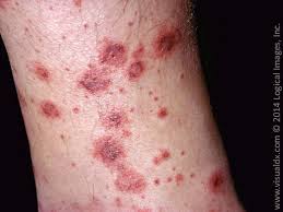 It is also known as bateman purpura, after british dermatology pioneer thomas bateman, who first described it in 1818; Learnderm Palpable Purpura