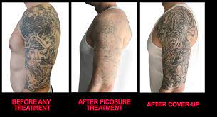 If you're like us, you love good body art and don't mind having visible tattoos that you like. Tattoo Removal For Cover Up Tattoos Laser Tattoo Removal