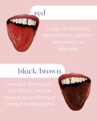 Image result for brown tongue symptoms